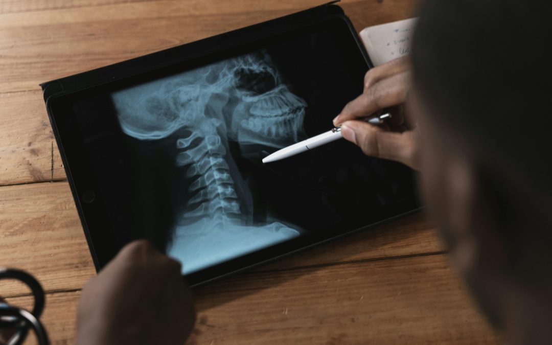 Osteoporosis vs Osteoarthritis